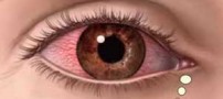 بیماری چشمی یوئیت + علائم و راه درمان
