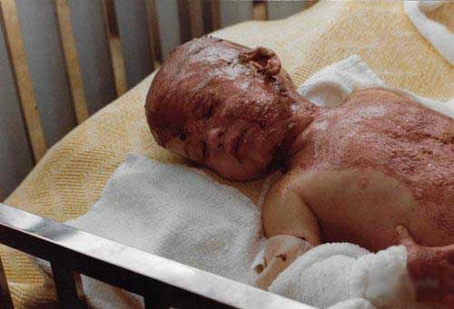 نوزادی که در ظرف روغن در حال سرخ شدن بود زنده ماند (عکس)