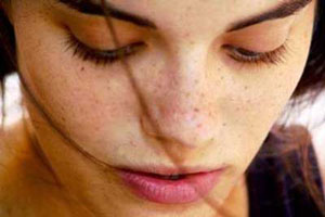 5 راه محو کردن لک های روی پوست