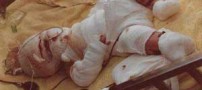 نوزادی که در ظرف روغن در حال سرخ شدن بود زنده ماند (عکس)