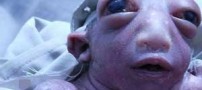 عکسهای تکان دهنده نوزادی با یک نصفه سر (عکس18+)