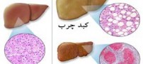درمان سنتی و سریع کبد چرب