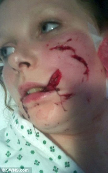 دختر زیبارویی که صورتش را سگ وحشی خورد! (عکس)