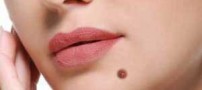 خال های صورت را با جراحی محو کنیم یا نکنیم؟