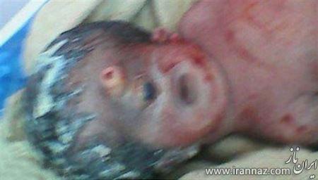 نوزادی که آلتش روی صورتش رشد کرده است (عکس) نوزادی که آلتش روی صورتش رشد کرده است (عکس)