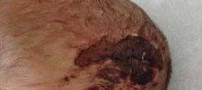 جمجمه نوزادی که در هنگام زایمان کنده شد (عکس)