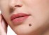 آیا خالهای شما نیاز به جراحی دارند؟
