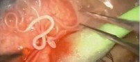 زندگی کردن کرم دو سانتی در چشم این فرد (عکس)