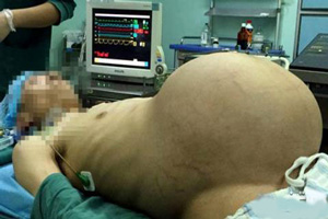 این تومور 15 کیلویی در شکم این مرد است (عکس)