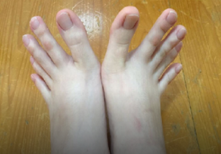 هم سایز بودن انگشتان دست و پای این دختر (عکس)