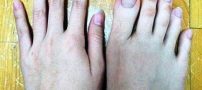 هم سایز بودن انگشتان دست و پای این دختر (عکس)