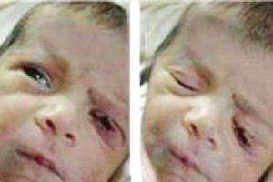 تیغ جراح پلک این جنین را هنگام عمل برید (عکس)