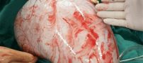 خارج کردن توده ی 7 کیلویی از شکم این زن ایرانی (عکس)