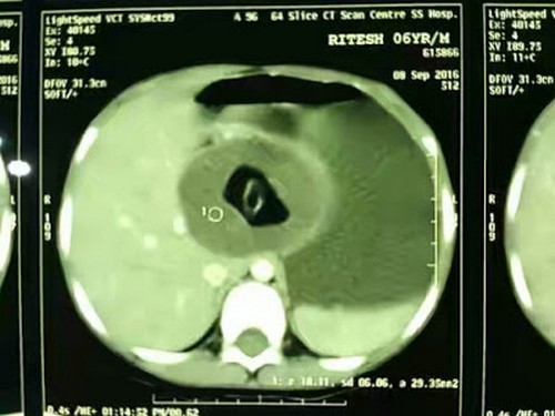 باردار شدن باورنکردنی پسر 6 ساله هندی (عکس) باردار شدن باورنکردنی پسر 6 ساله هندی (عکس)