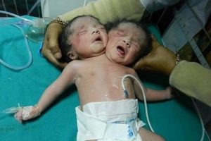 متولد شدن پسر دوسر در هندوستان (عکس)
