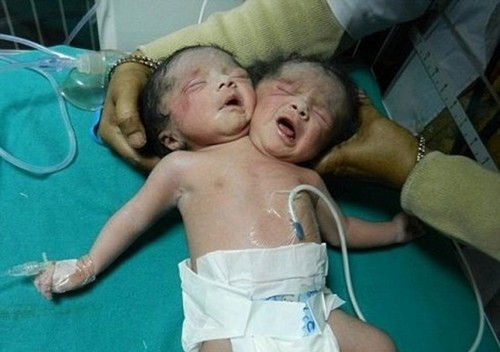 متولد شدن پسر دوسر در هندوستان (عکس)