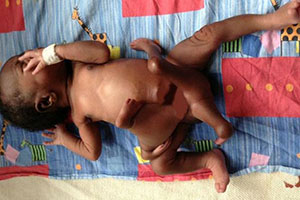 نوزادی با هشت دست و پا بدنیا آمد +تصاویر