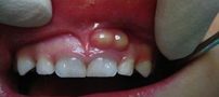 درمان آبسه دندان با خوردن این مواد غذایی