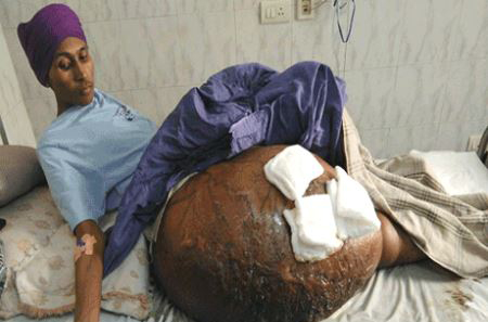 تومور 55 کیلویی در بدن این پسر (عکس)