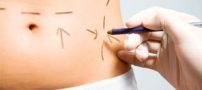 کدام بهتر است: رژیم و ورزش یا لیپوساکشن
