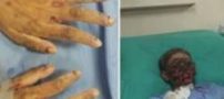 دختری که بخاطر مصرف دارو شبیه زامبی ها شد (عکس 18+)