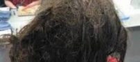 دختری با موهای بسیار زشت و پر شپش (عکس)