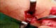 خارج کردن کرم ده سانتی از صورت این مرد (عکس)