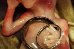 ماجرای دردناک سقط جنین 14 هفته ای (عکس18+)
