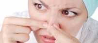 برطرف کردن جوش های سر سیاه بینی