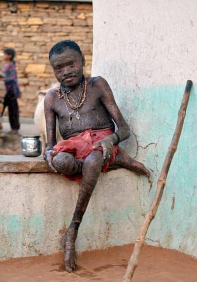 بیماری عجیب و وحشتناک این مرد آفریقایی (عکس)