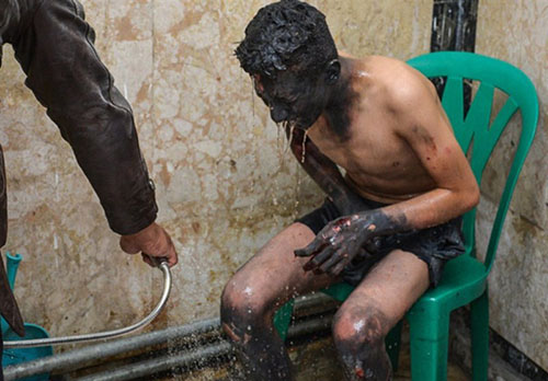 عکس های دلخراش مصدومین چهارشنبه سوری 96 عکس های دلخراش مصدومین چهارشنبه سوری 96