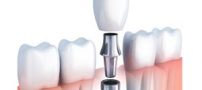 ایمپلنت دندان چیست و چه کاربردی دارد