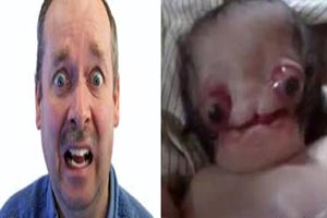 ترسناک ترین نوزاد عجیب الخلقه جهان متولد شد 18+ (عکس)