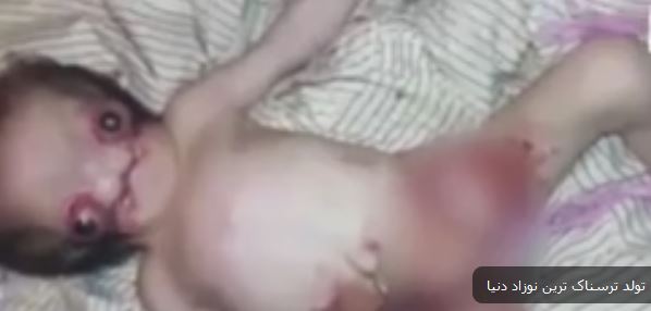 ترسناک ترین نوزاد عجیب الخلقه جهان متولد شد 18+ (عکس)