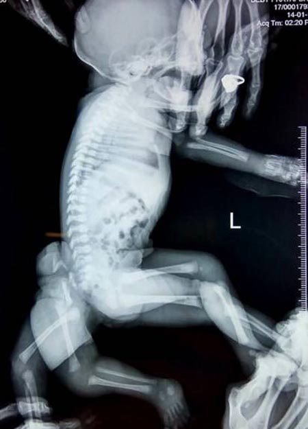 جراجی زیبایی نوزاد دختری که خبر ساز شد + تصاویر دیدنی جراجی زیبایی نوزاد دختری که خبر ساز شد + تصاویر دیدنی