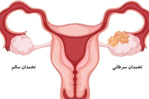 سرطان تخمدان در زنان کشنده است یا نه
