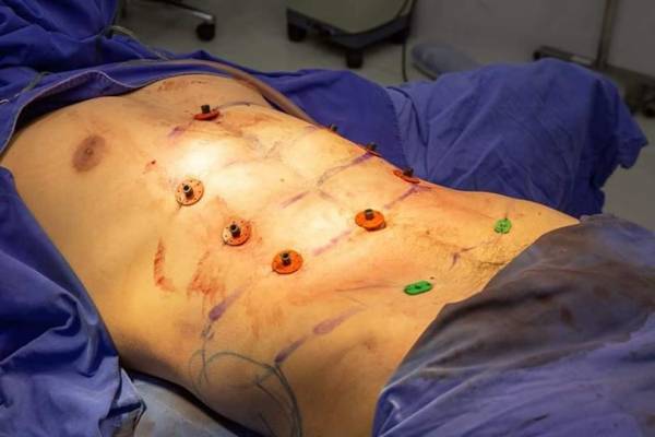جراحی عجیب سیکس پک کردن شکم در تایلند (عکس)