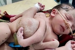 تولد نوزاد دختر با ۴ پا و ۳ دست (عكس)