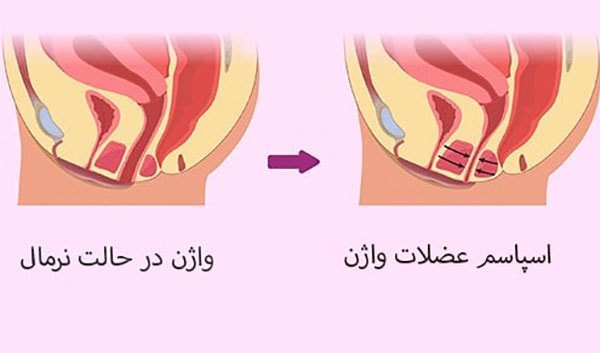 همه چیز درباره واژینیسموس یا واژینیسم Vaginismus همه چیز درباره واژینیسموس یا واژینیسم Vaginismus