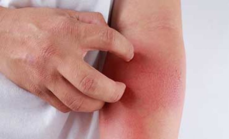 دلیل اصلی خارش شدید پوست + درمان دلیل اصلی خارش شدید پوست + درمان