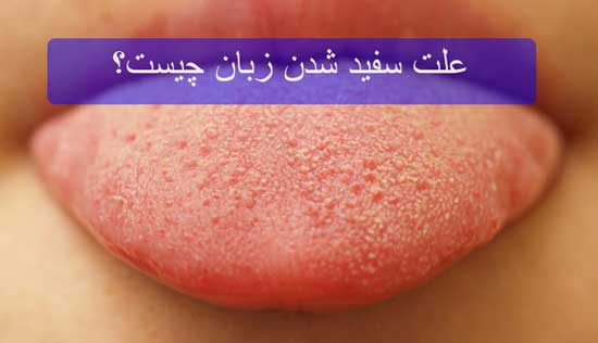 علت سفید شدن زبان چیست؟ علت سفید شدن زبان چیست؟