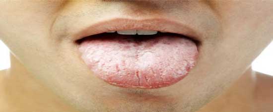 علت سفید شدن زبان چیست؟ علت سفید شدن زبان چیست؟