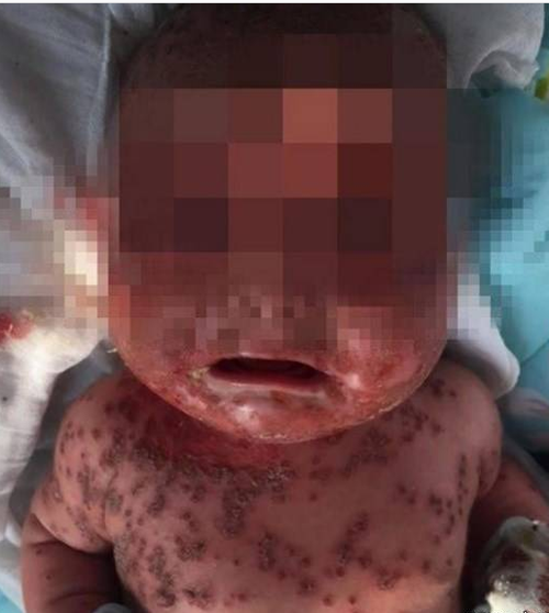 عفونت وحشتناک این نوزاد بعد از بوسه (عکس)