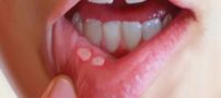خوراکی های مضر و مفید برای آفت دهان