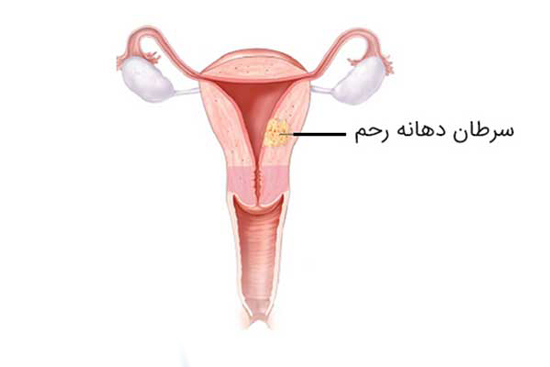 همه چیز درباره کولپوسکوپی دهانه رحم