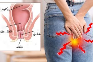 اگر مقعدتان جوش میزند این مطلب را بخوانید