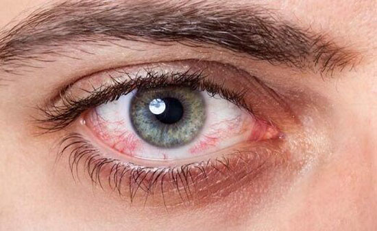 قرمزی چشم را چگونه درمان کنیم | دلایل قرمزی چشم