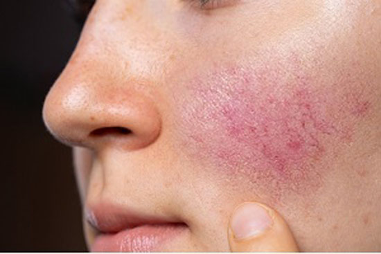 همه چیز درباره بیماری پوستی روزاسه همه چیز درباره بیماری پوستی روزاسه