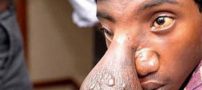 پسری که بینی عجیب شبیه بیضه دارد + عکس