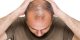 آیا کرونا باعث ریزش مو میشود؟